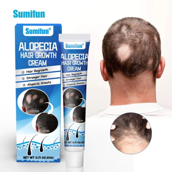 Alopecia Hair Growth Cream 100% proven working